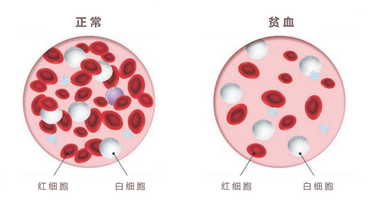 癌症常会引起贫血，不明原因的贫血要警惕