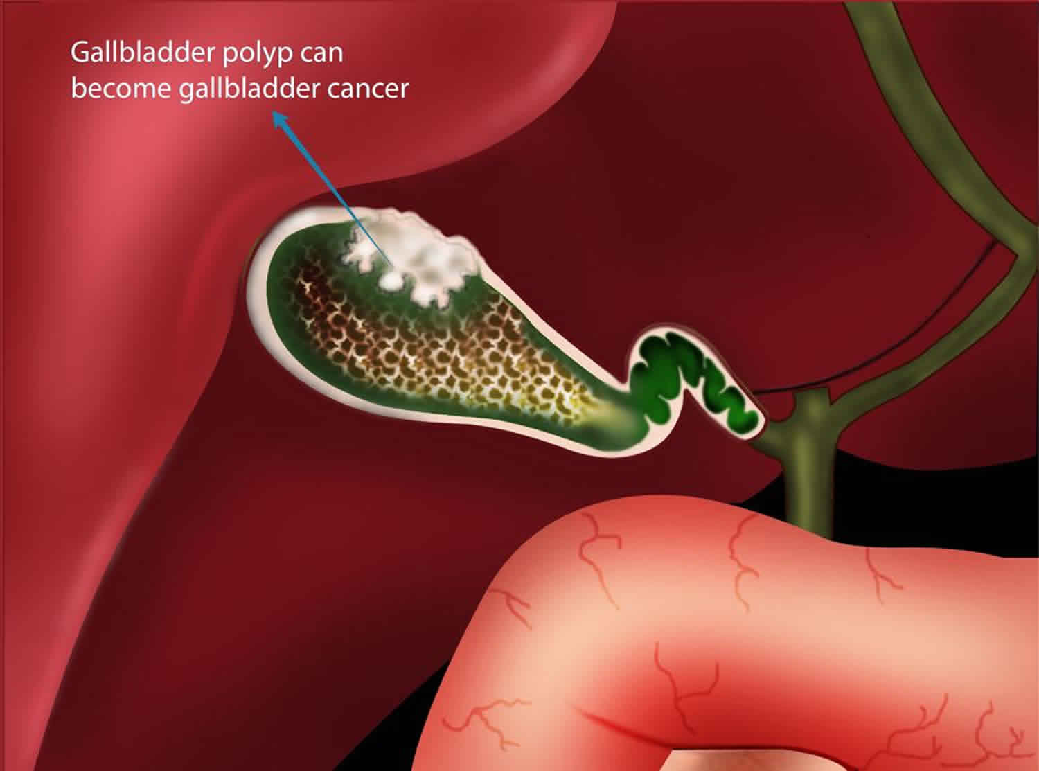 gallbladder_polyps.jpg