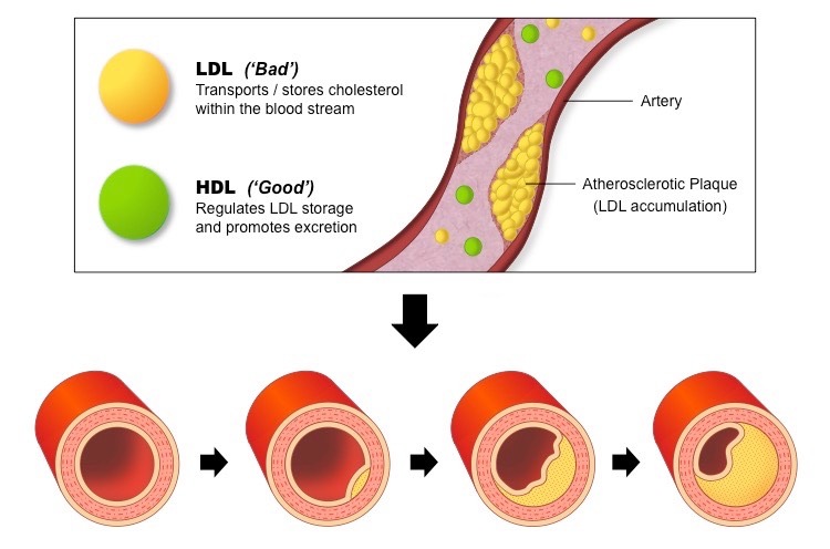atherosclerotic-plaque_med.jpeg