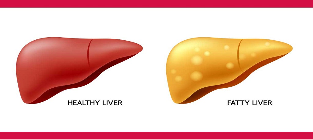 Liver-Doctor-Fatty-Liver.jpg